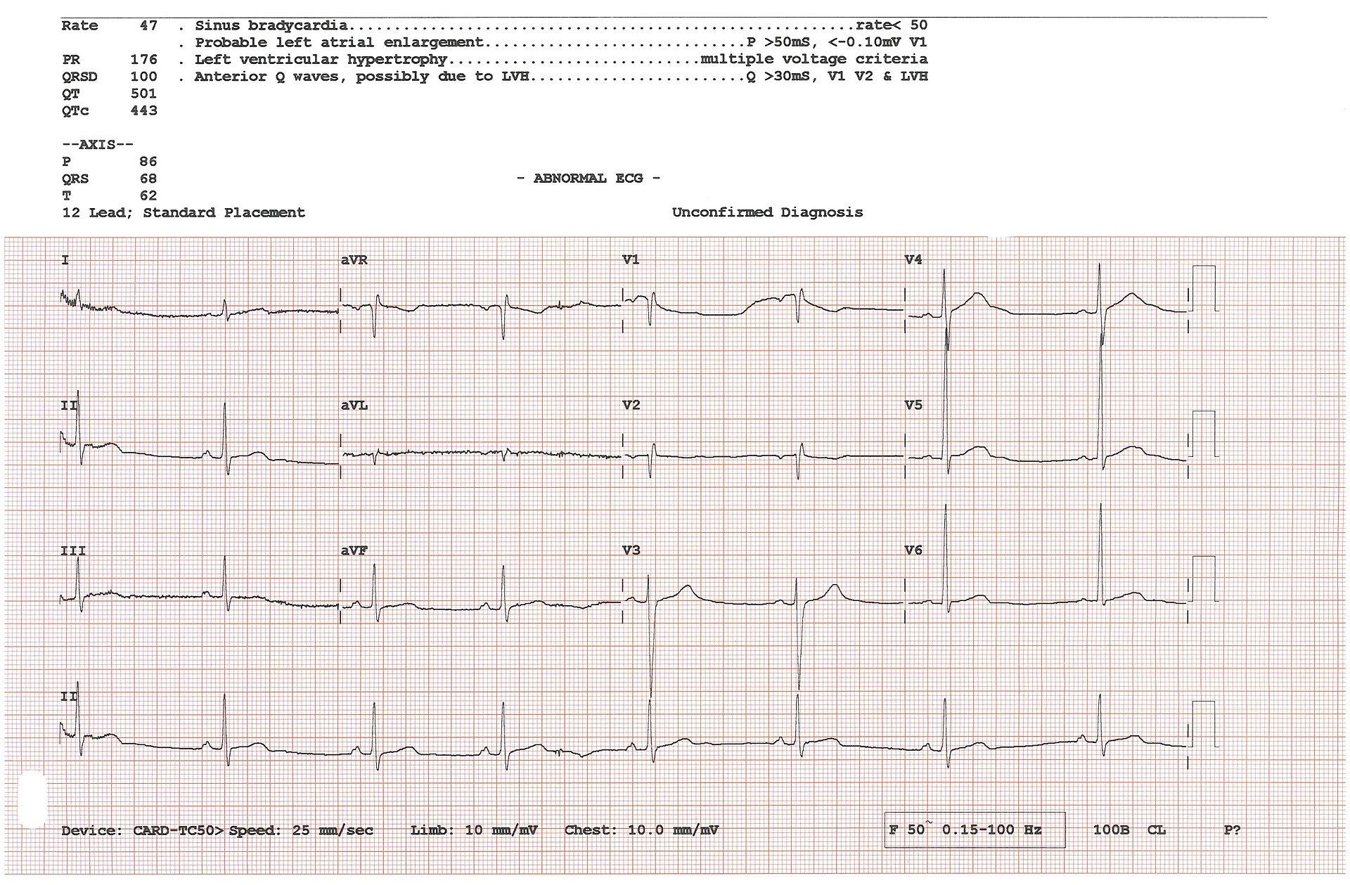 A twelve lead electrocardiogram printout showing the rhythm of a heart. A Wikimedia Commons photograph on Brent O'Mara Insights.